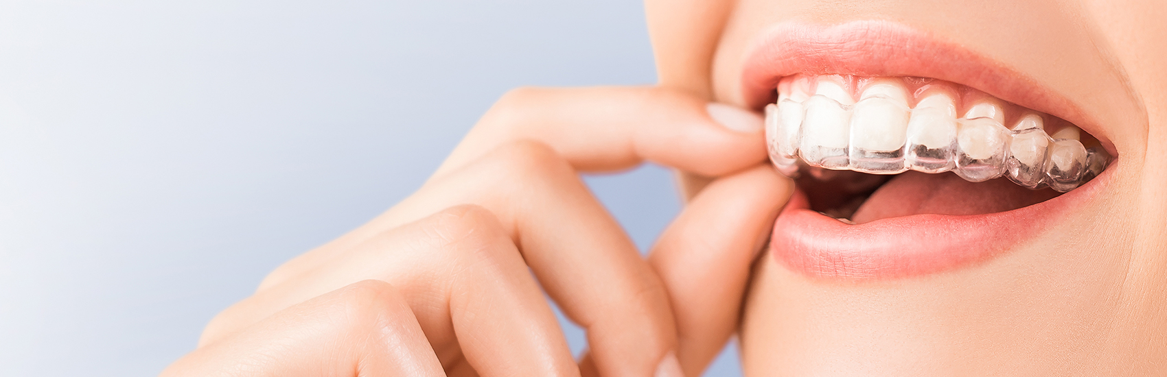 Invisalign For Teens Invisalign For Teens