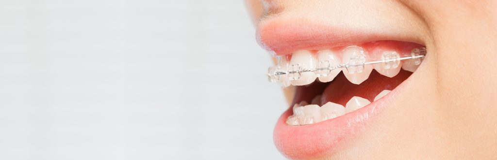 Common Orthodontic Treatment